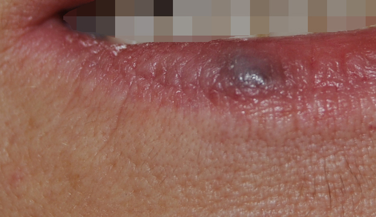 Venous Lake in Lip